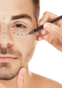 Blefaroplastia no quirúrgica con Plasma pen
